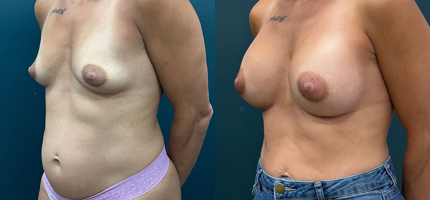 Breast Augmentation Before & After