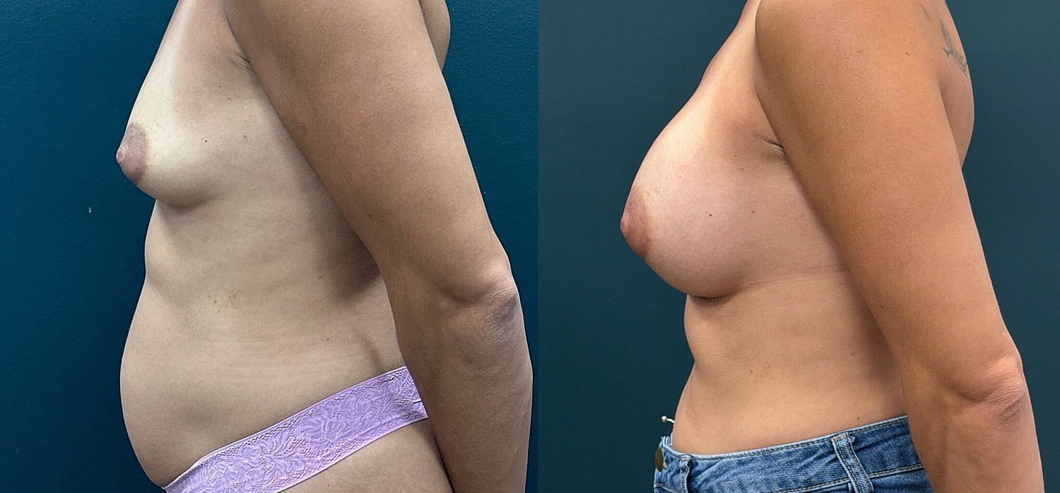 Breast Augmentation Before & After