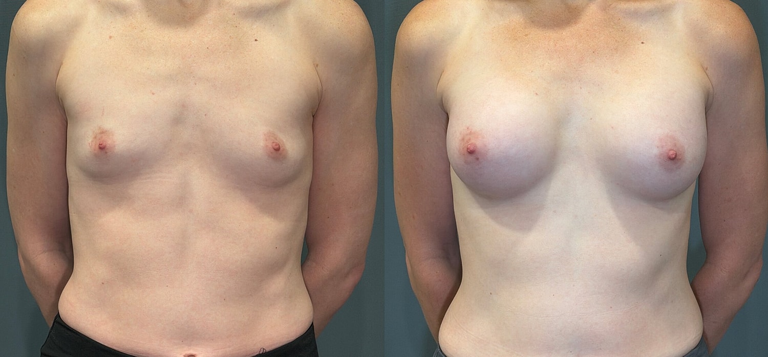 Breast Augmentation Before & After