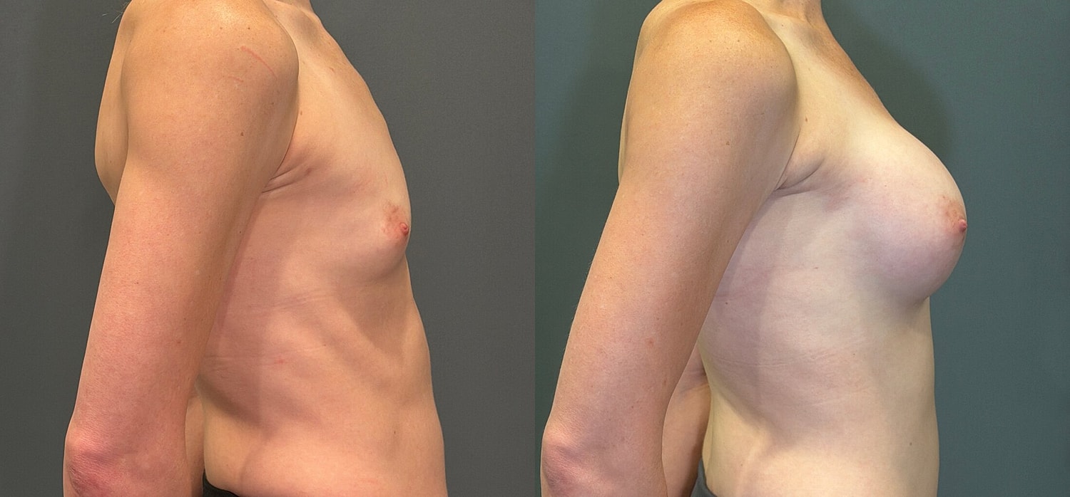 Breast Augmentation Before & After