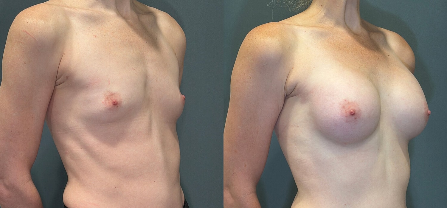 Breast Augmentation Before & After