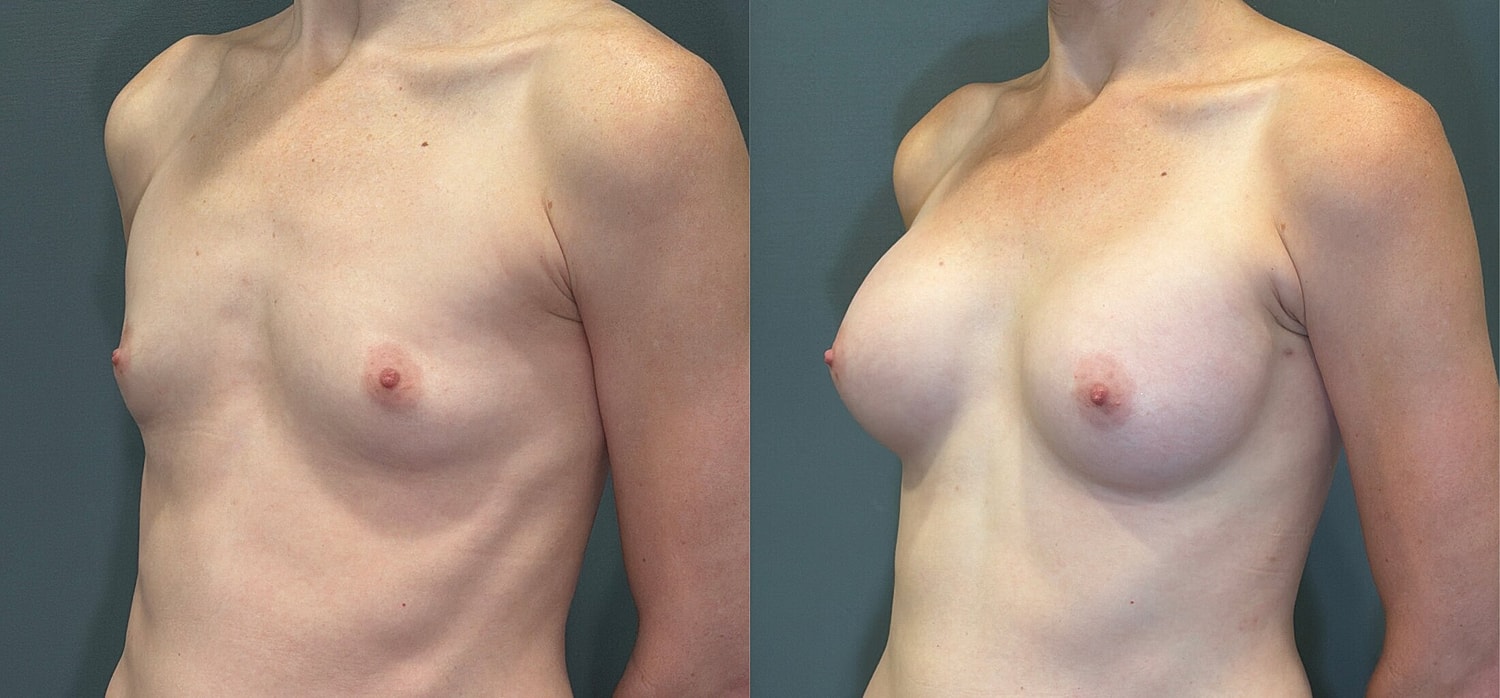 Breast Augmentation Before & After
