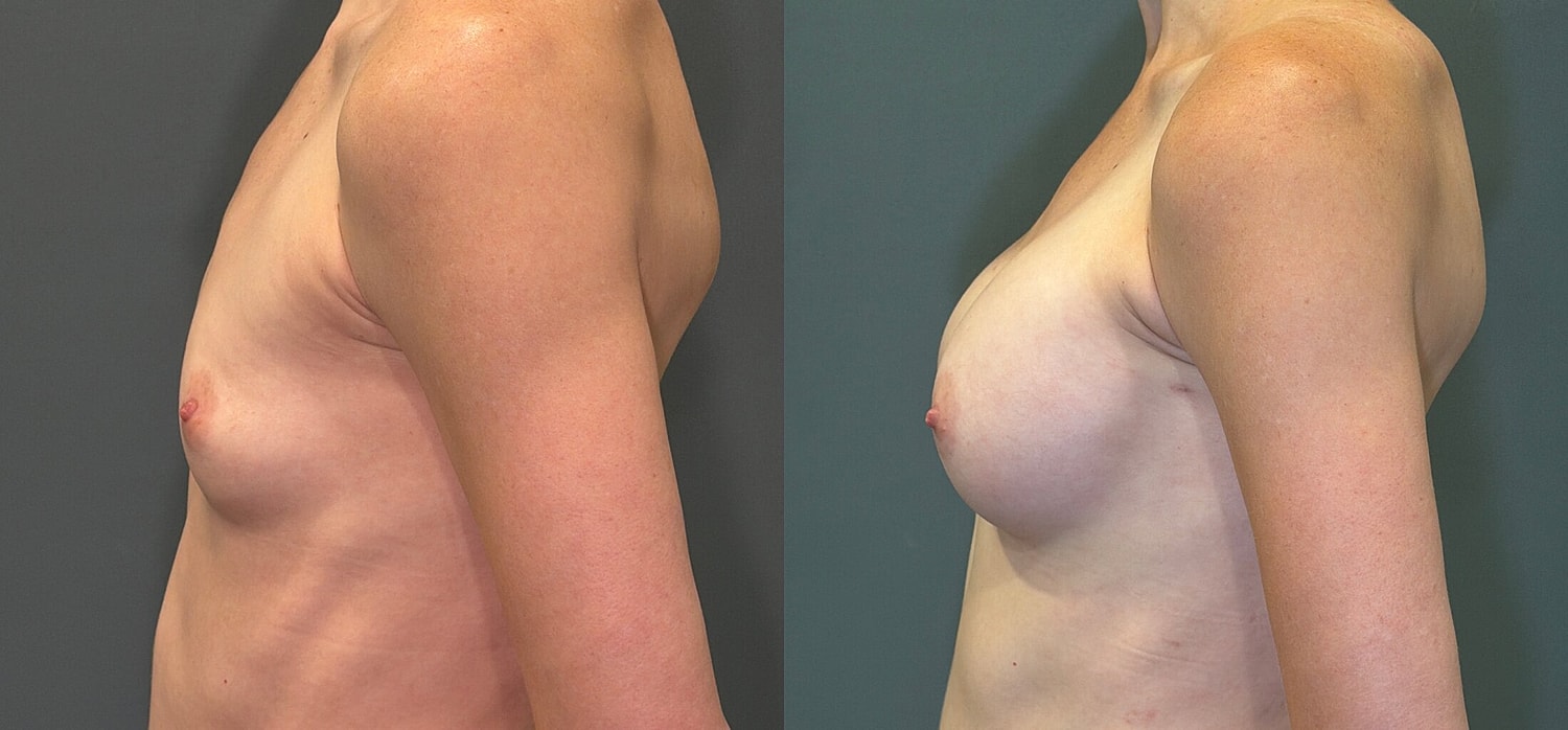 Breast Augmentation Before & After