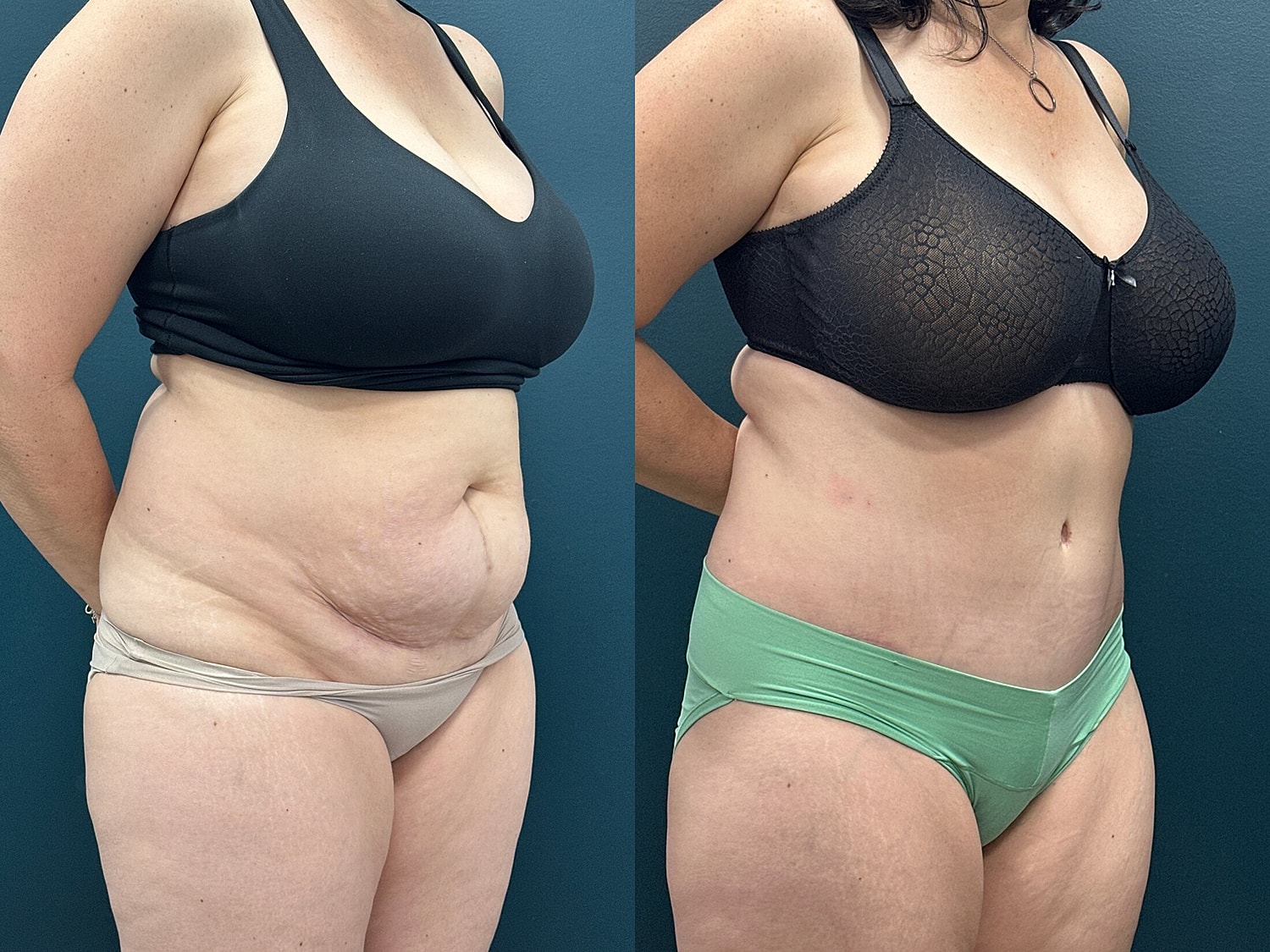 Tummy Tuck Before & After
