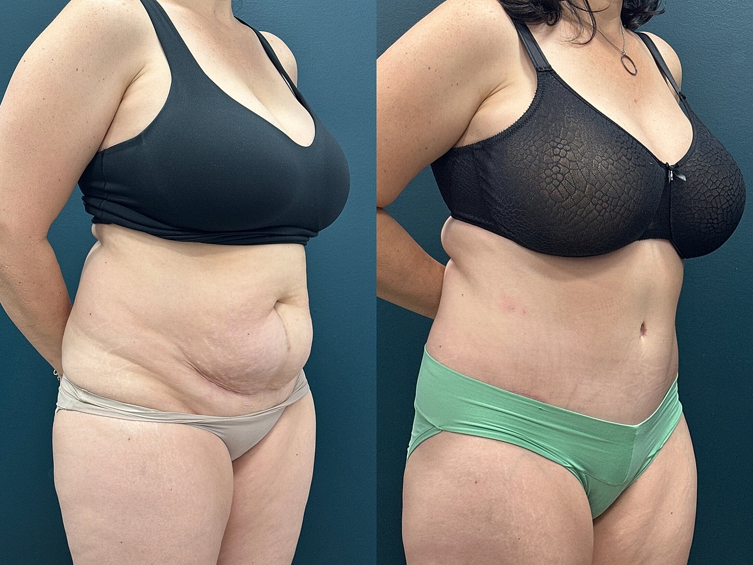 Tummy Tuck Before & After