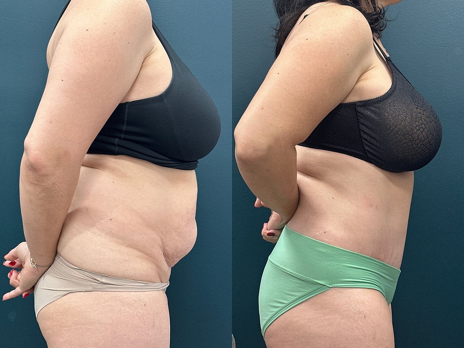 Tummy Tuck Before & After