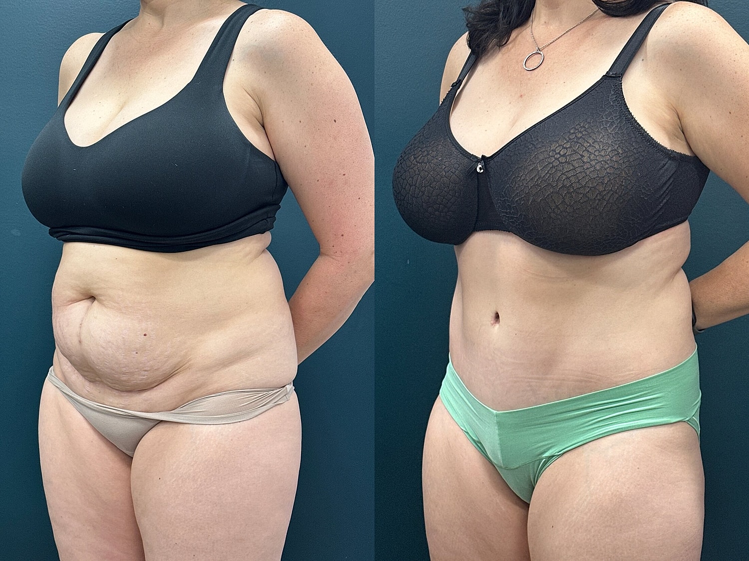 Tummy Tuck Before & After