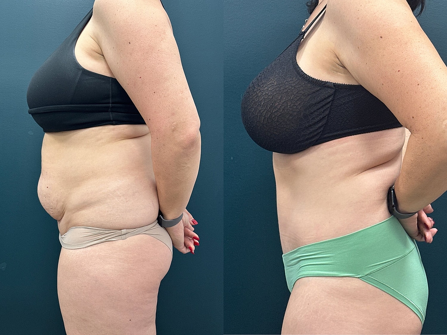 Tummy Tuck Before & After