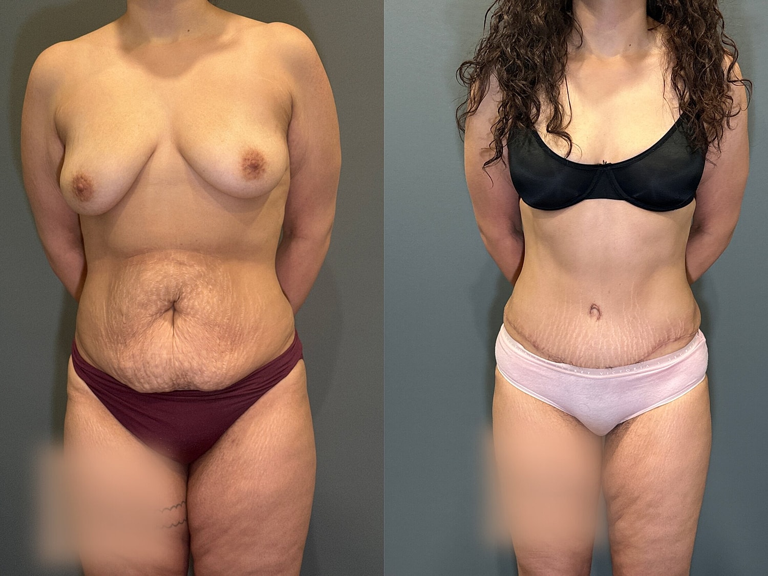 Tummy Tuck Before & After