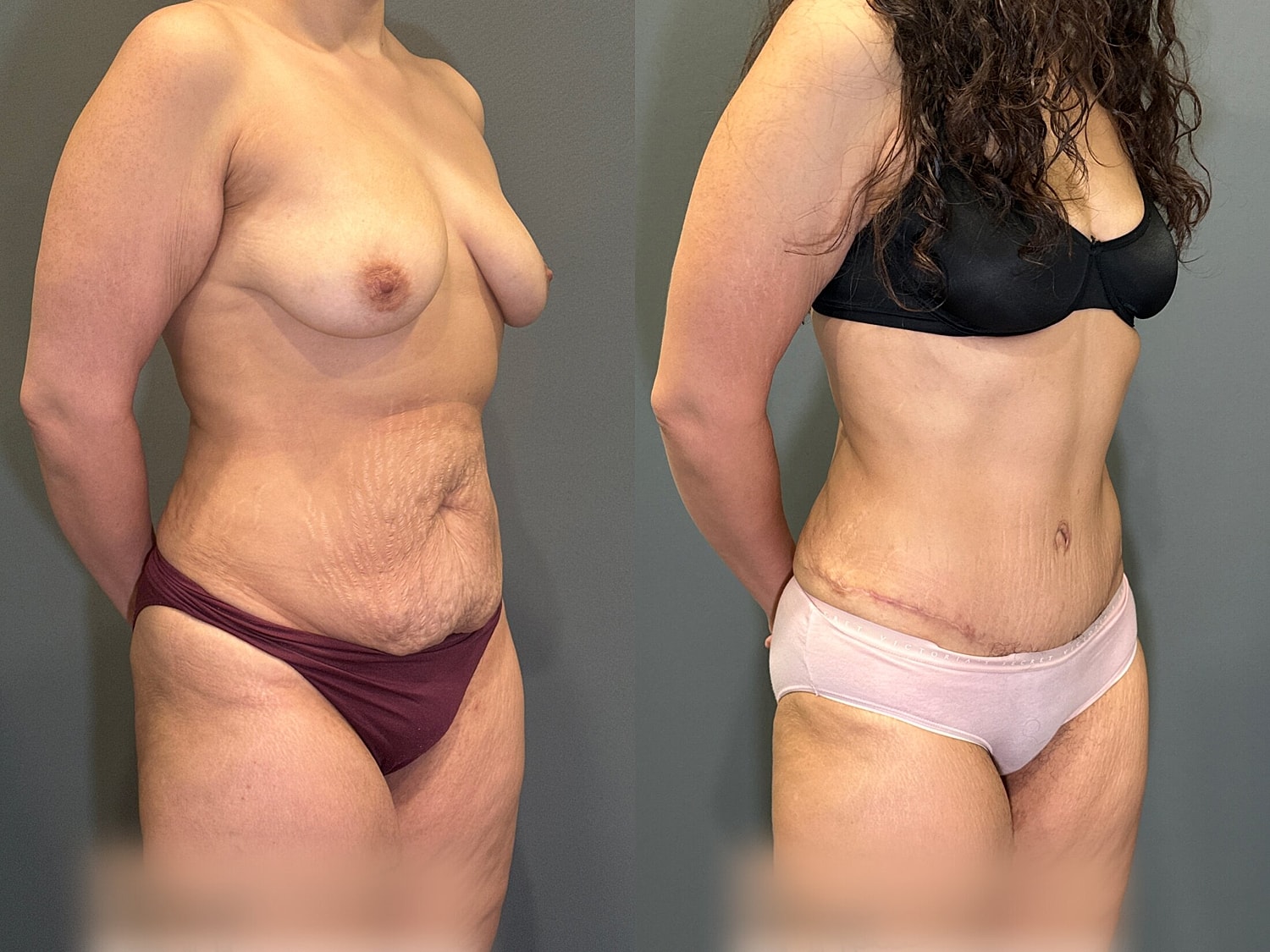 Tummy Tuck Before & After