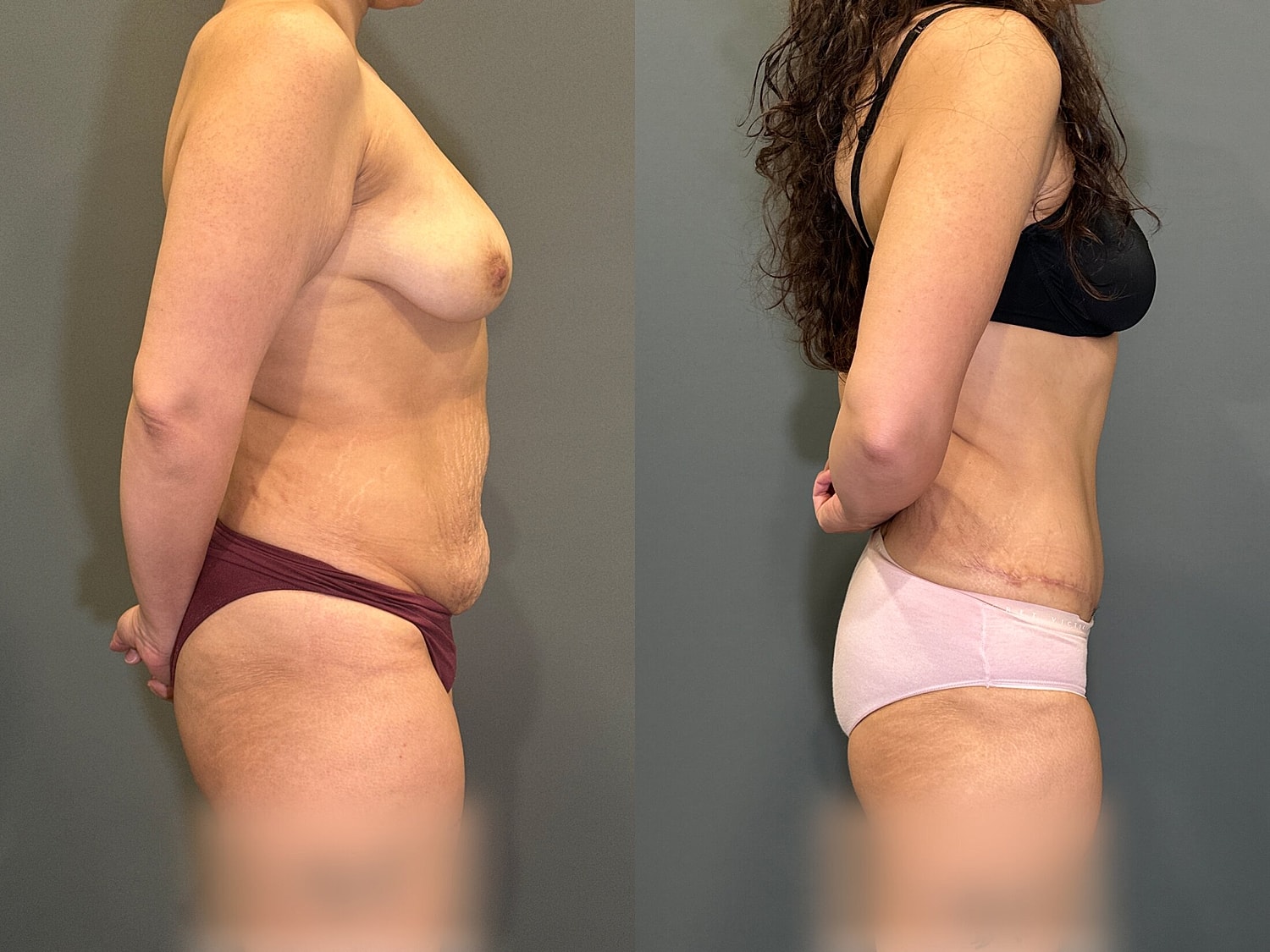 Tummy Tuck Before & After