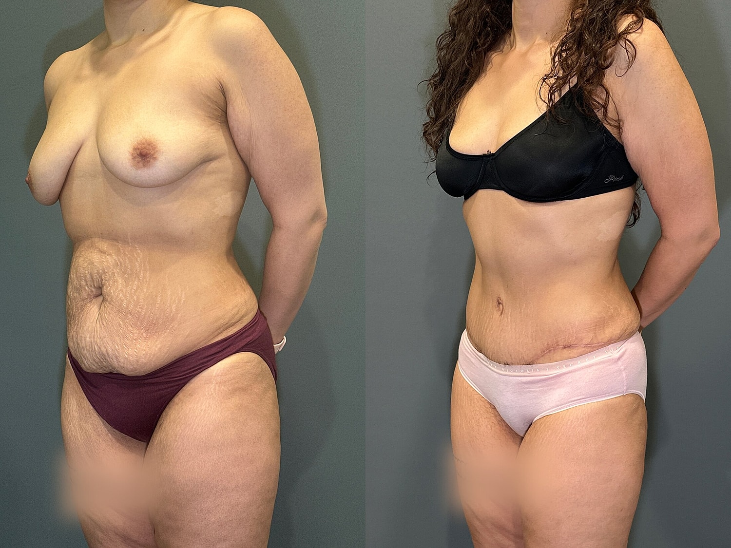 Tummy Tuck Before & After