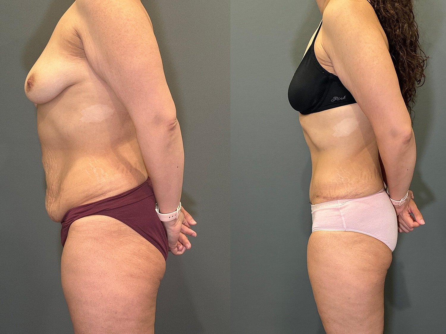 Tummy Tuck Before & After