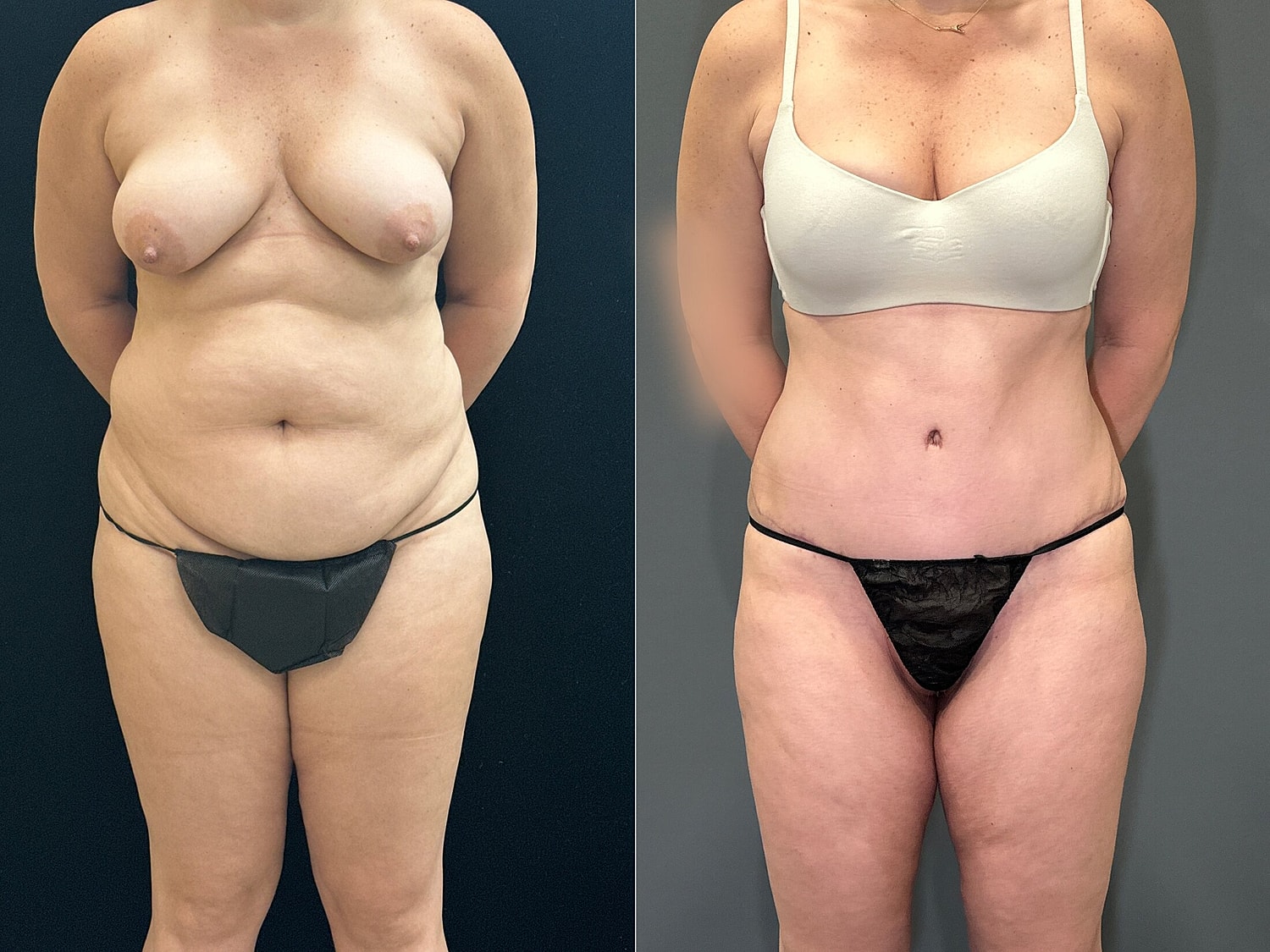 Tummy Tuck Before & After