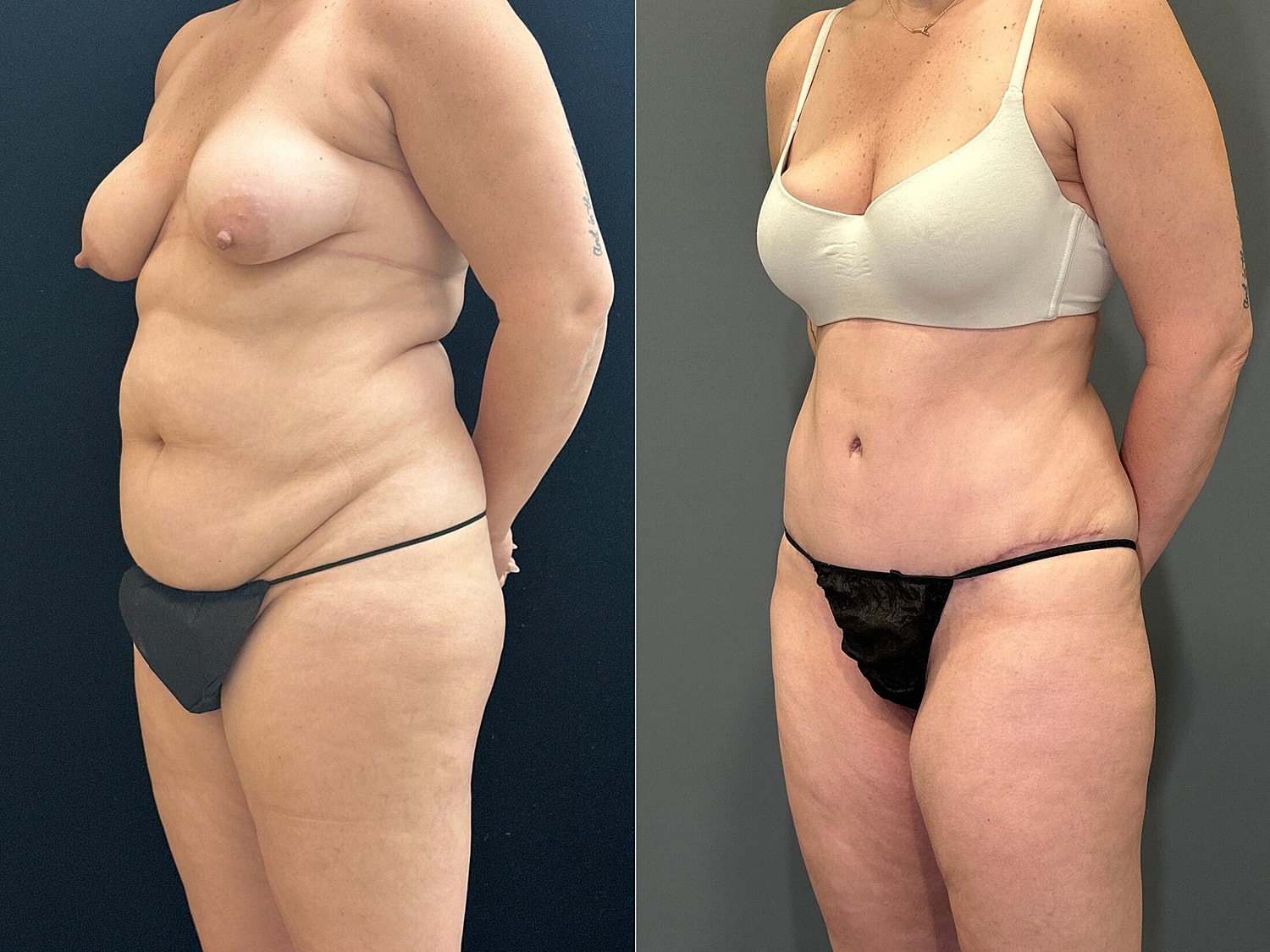 Tummy Tuck Before & After