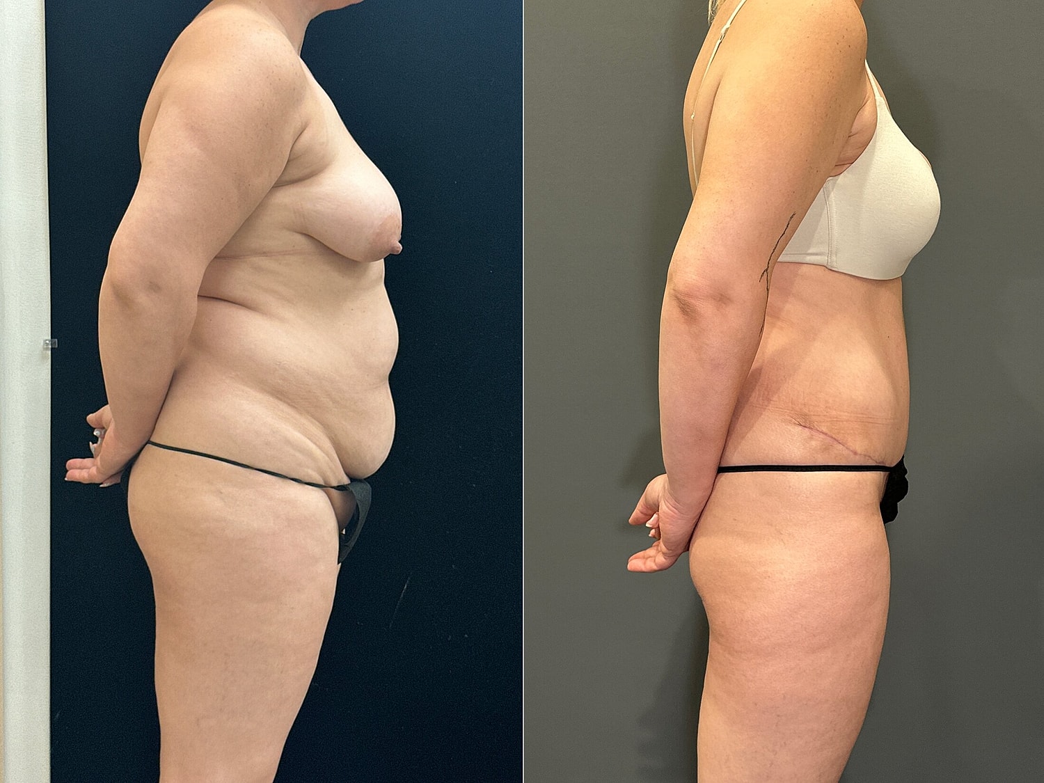 Tummy Tuck Before & After