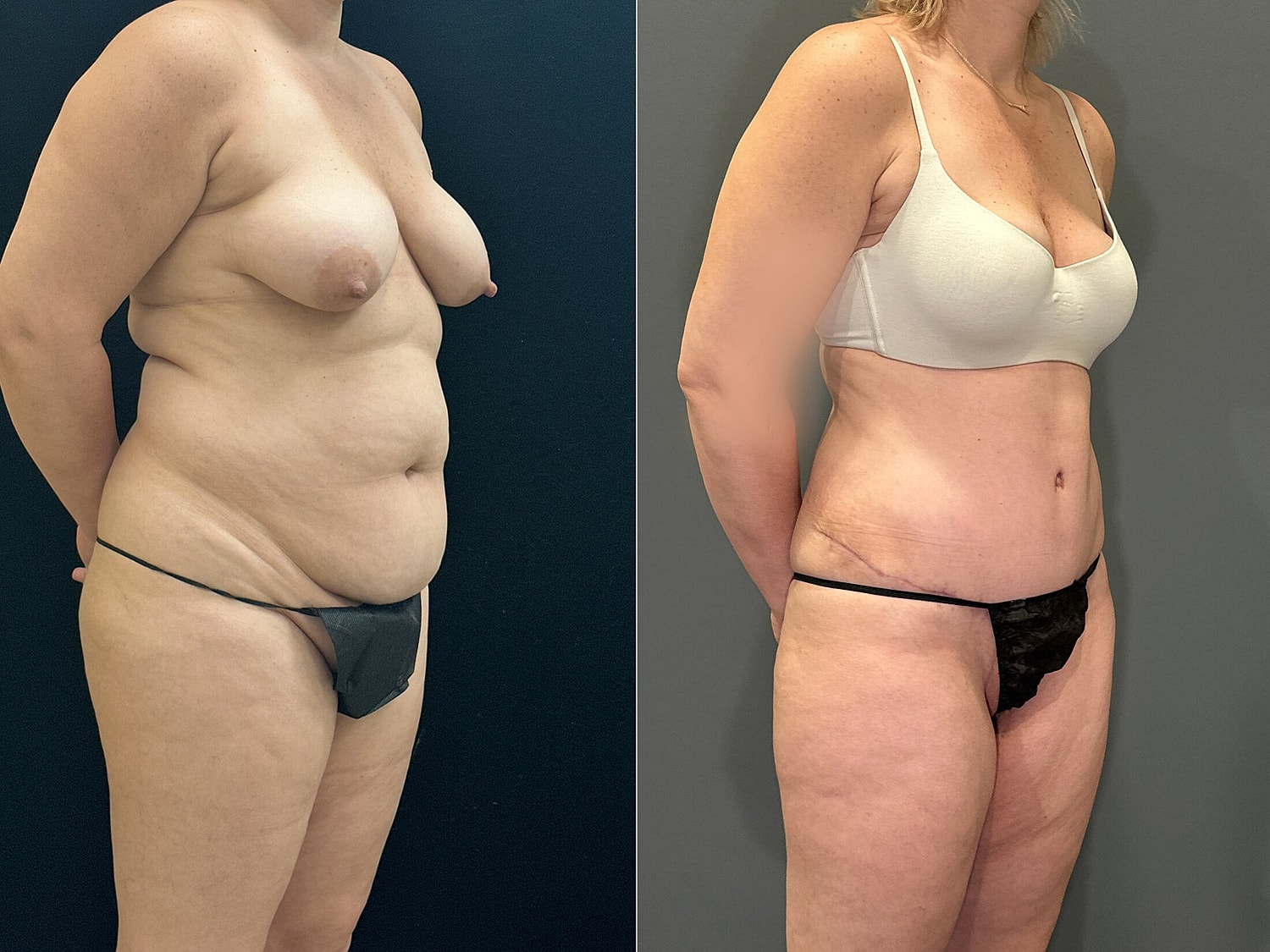 Tummy Tuck Before & After