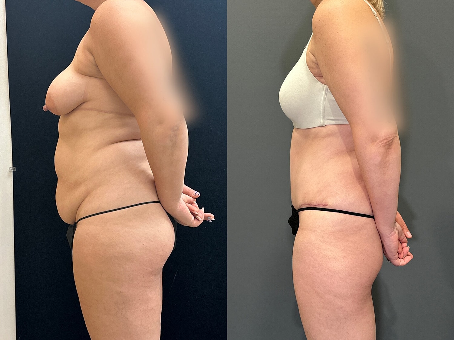 Tummy Tuck Before & After