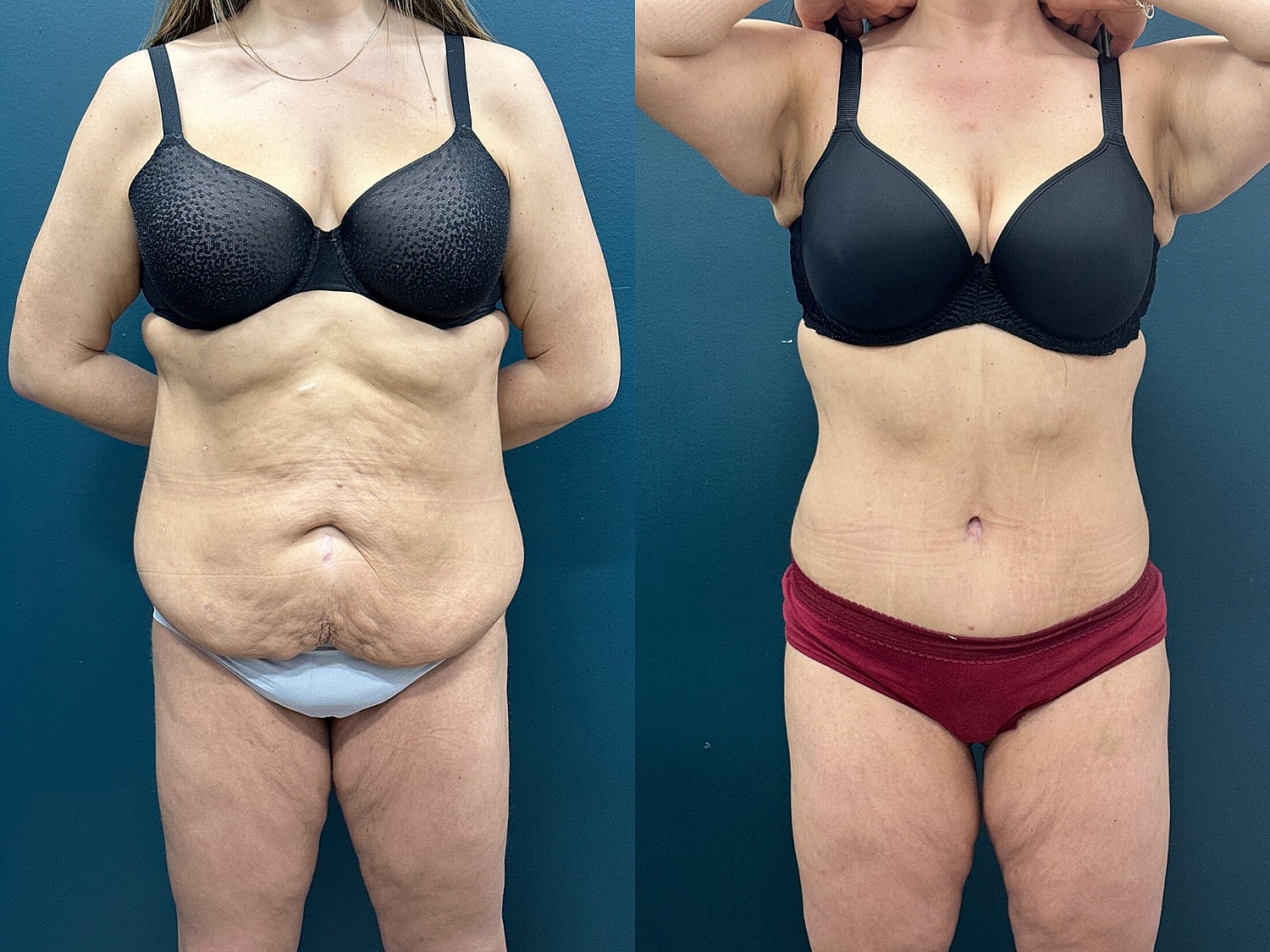 Tummy Tuck Before & After
