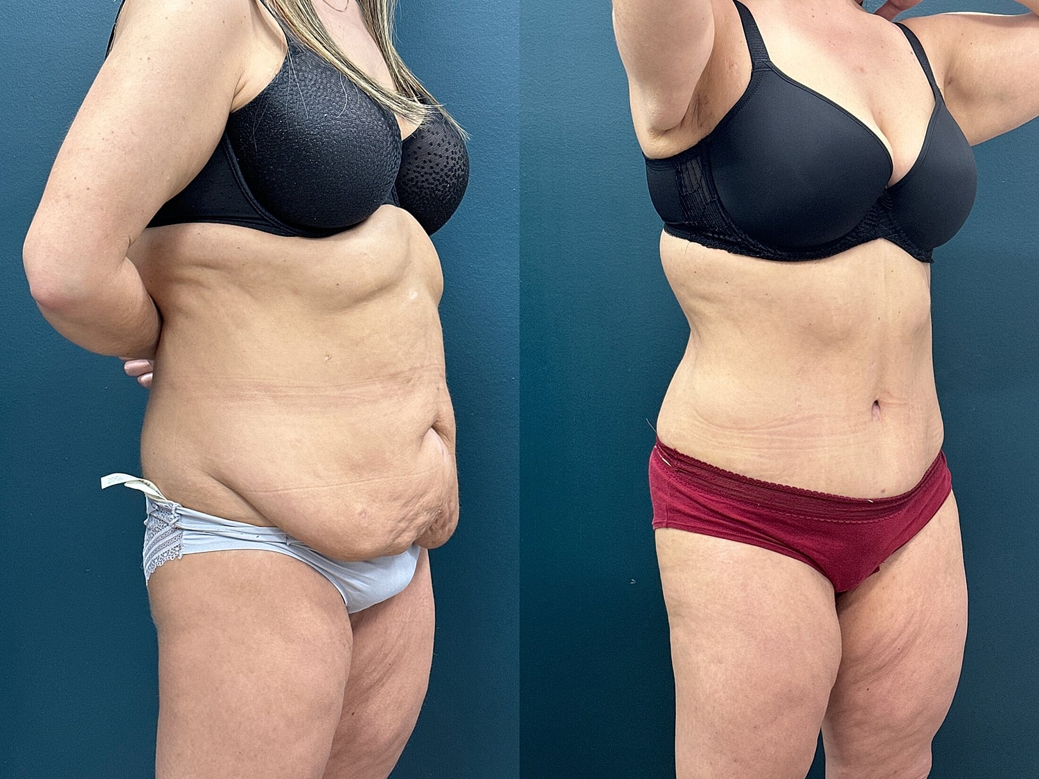 Tummy Tuck Before & After