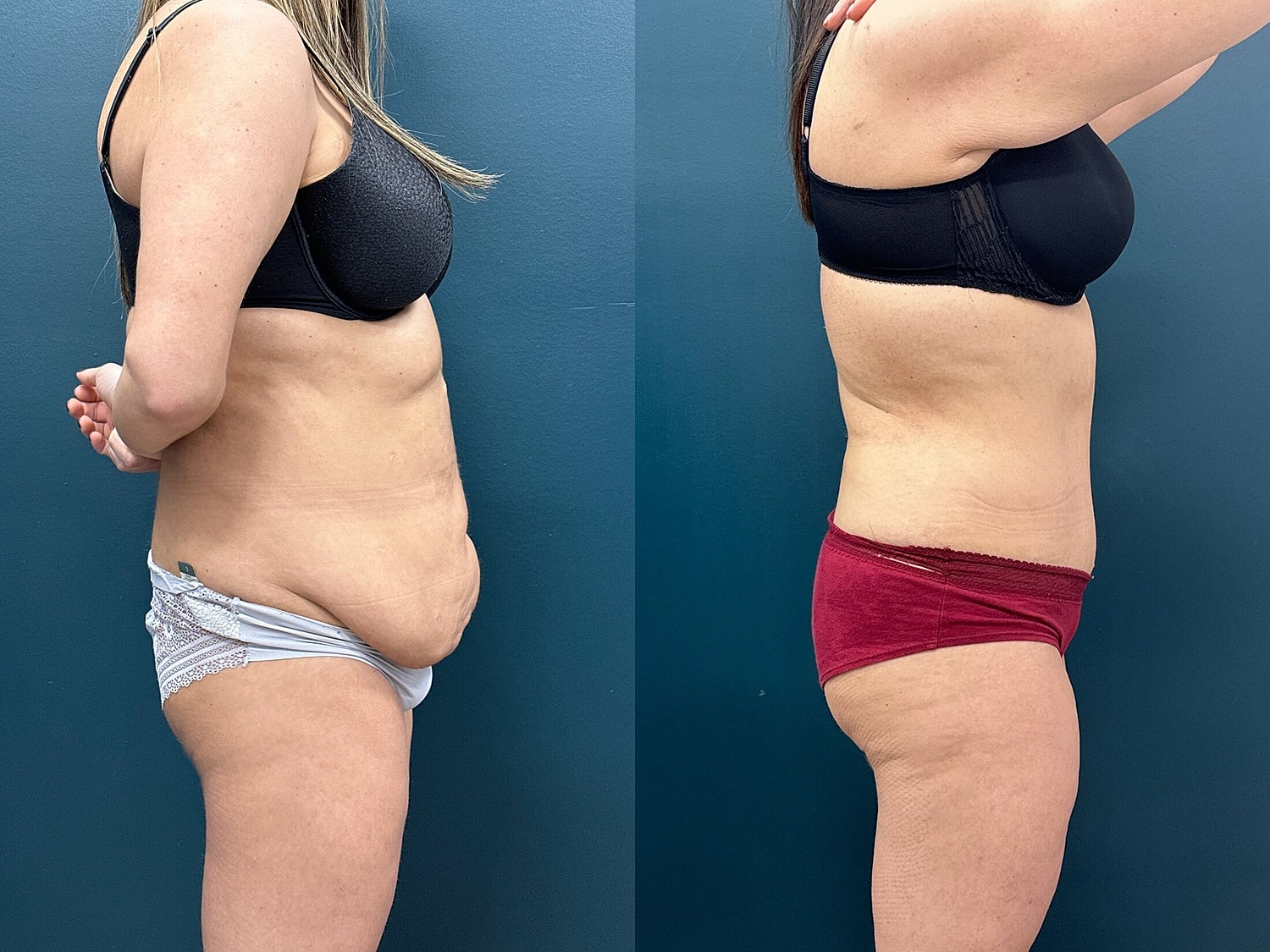 Tummy Tuck Before & After