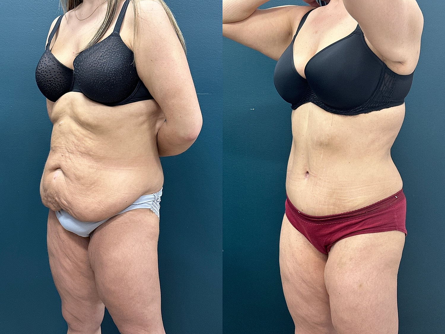 Tummy Tuck Before & After