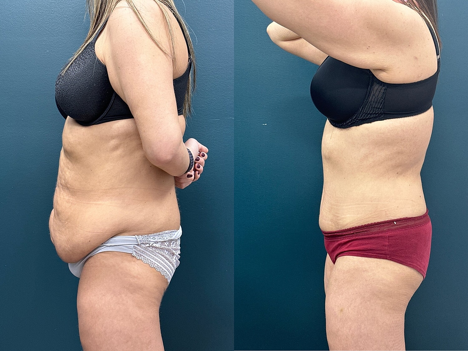 Tummy Tuck Before & After