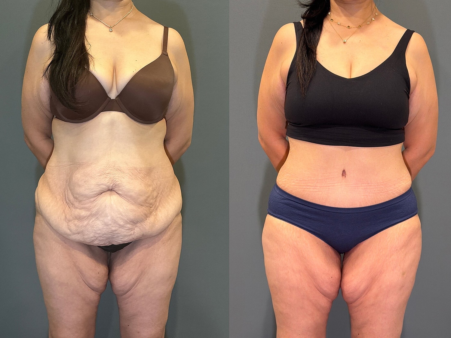 Tummy Tuck Before & After