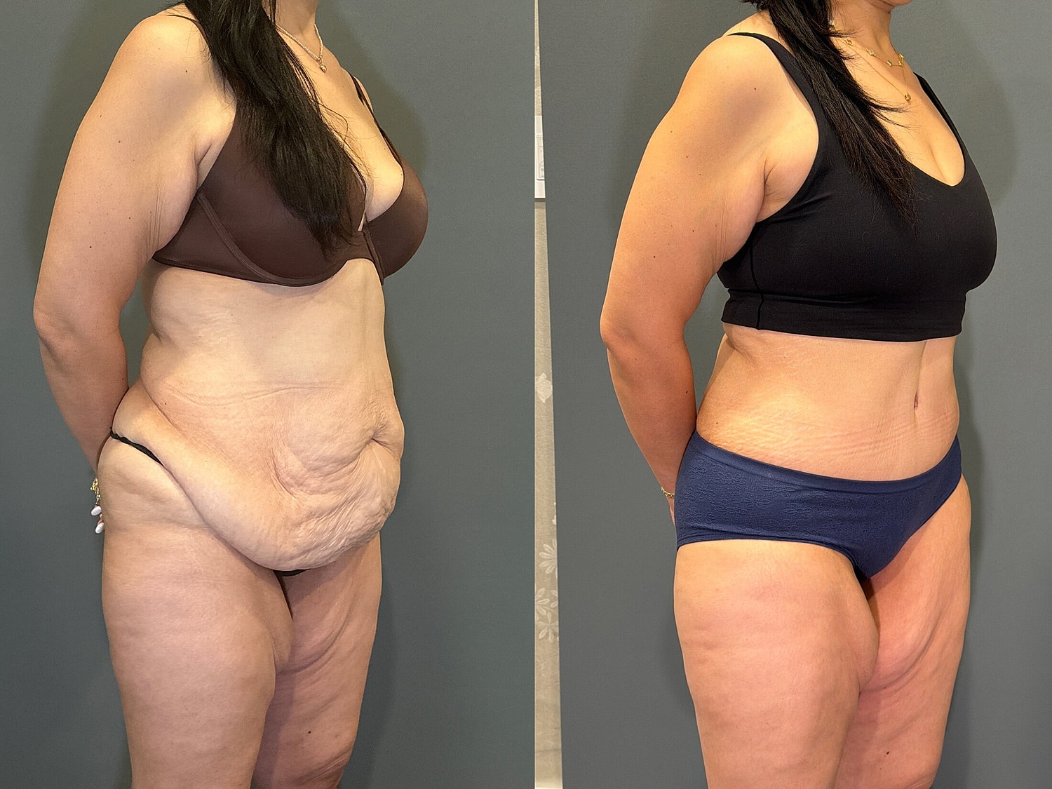 Tummy Tuck Before & After