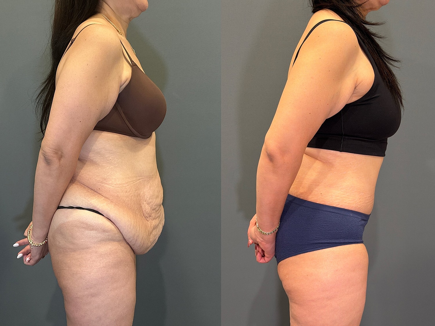 Tummy Tuck Before & After
