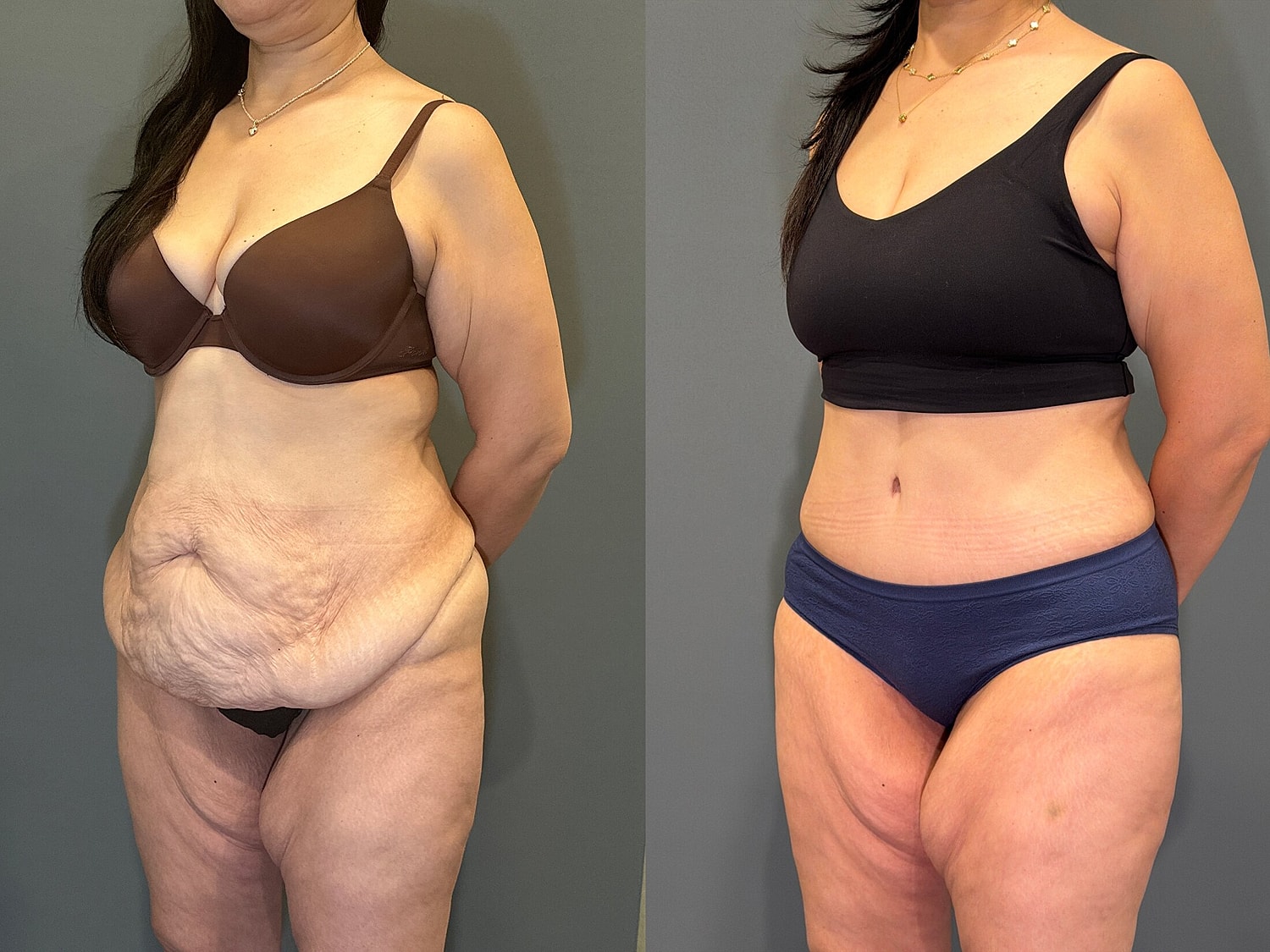 Tummy Tuck Before & After