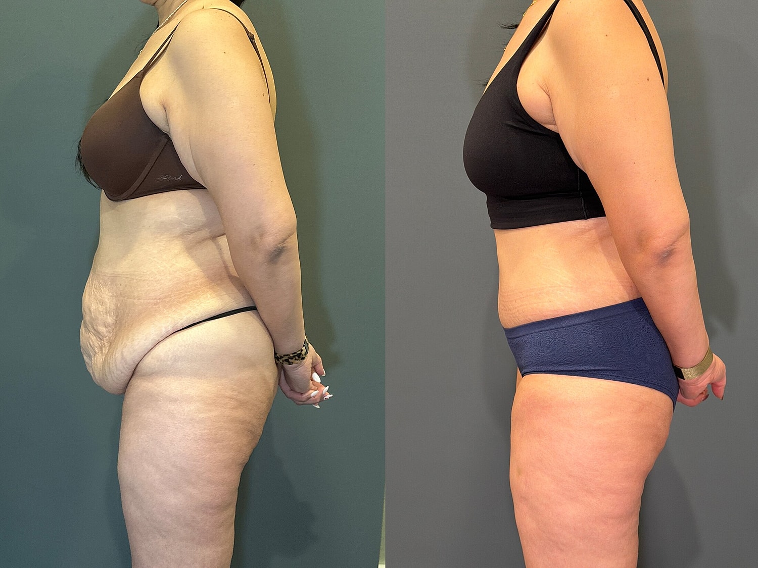 Tummy Tuck Before & After