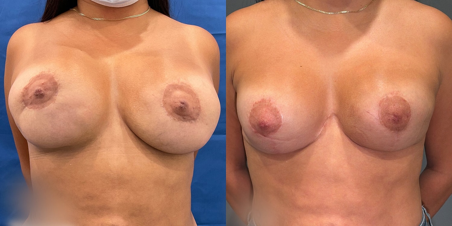 Breast Reconstruction Before & After
