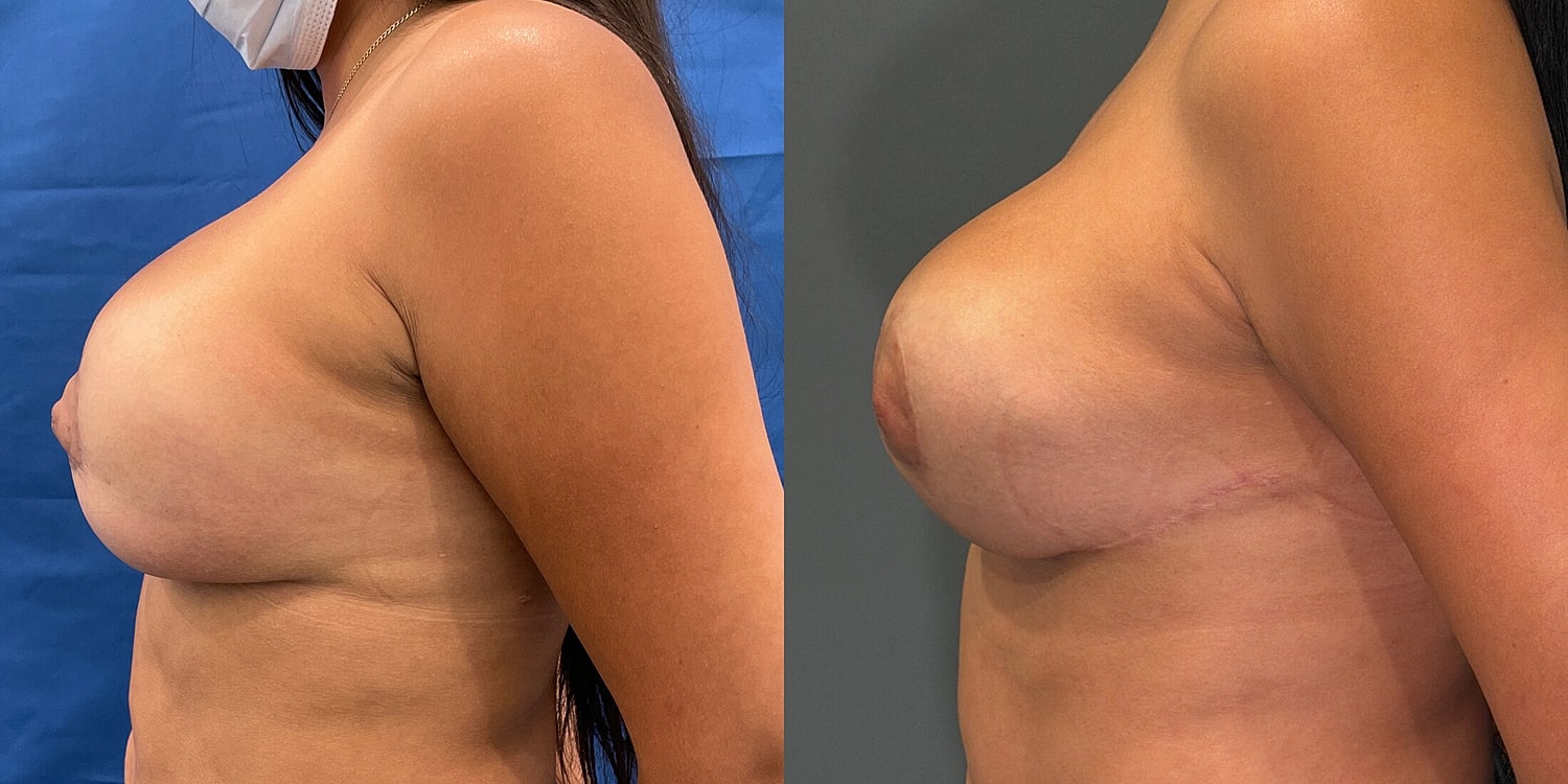 Breast Reconstruction Before & After