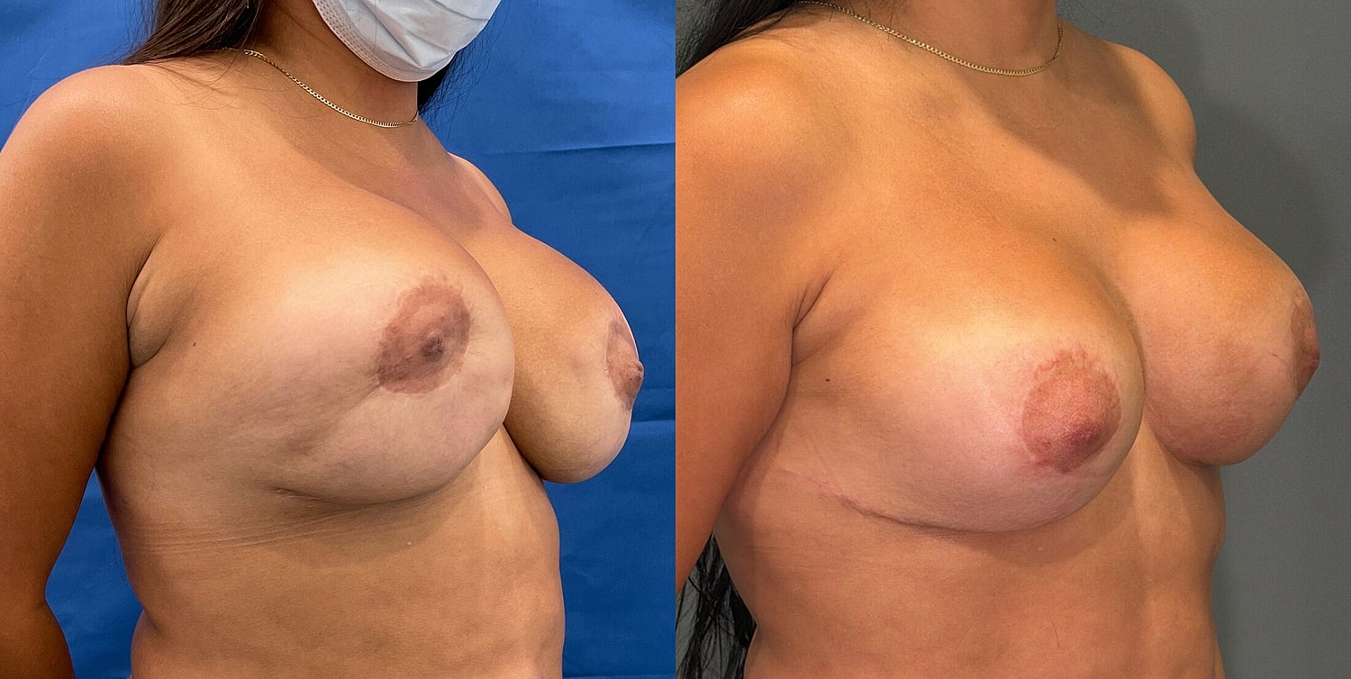 Breast Reconstruction Before & After