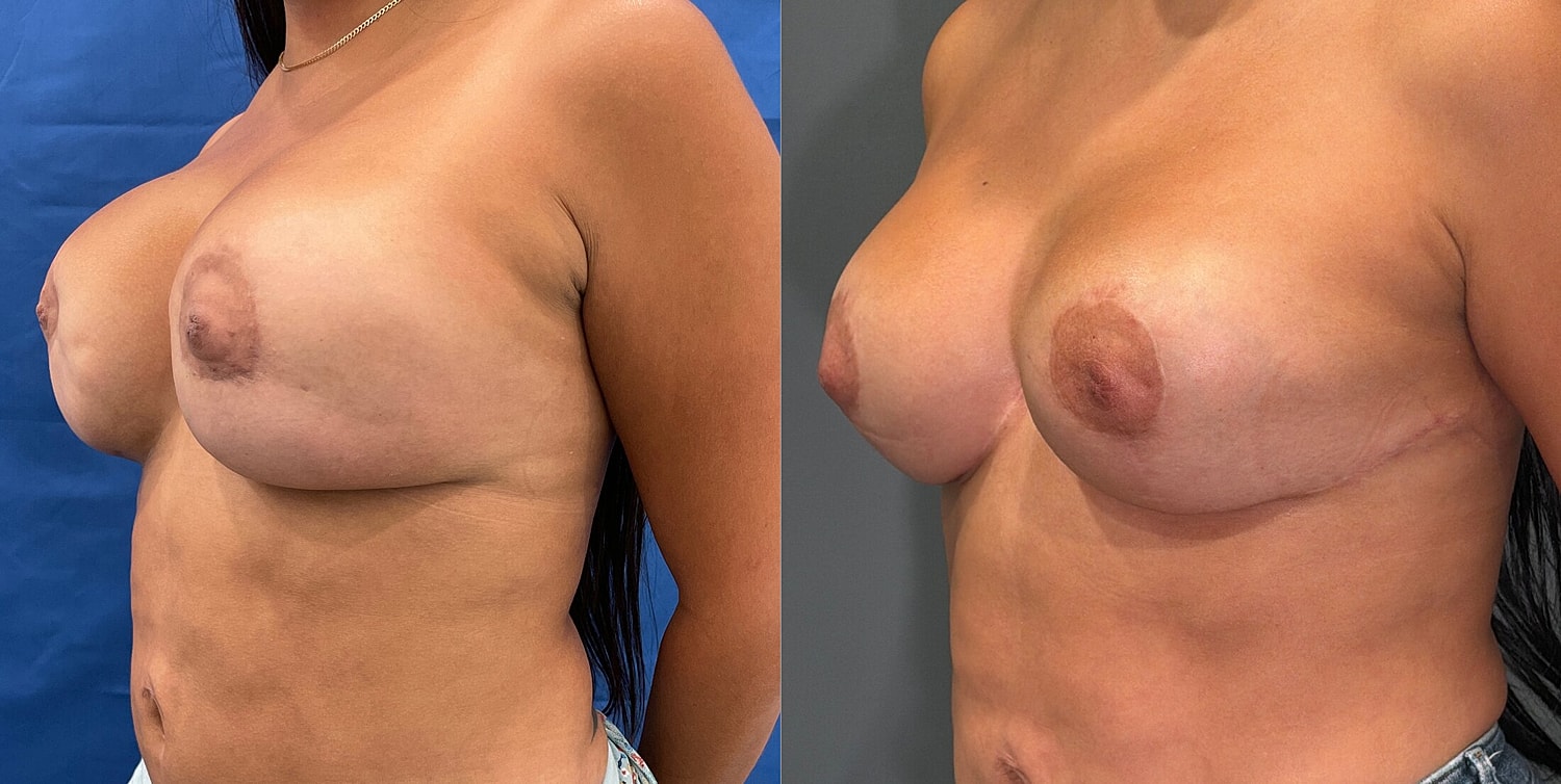Breast Reconstruction Before & After