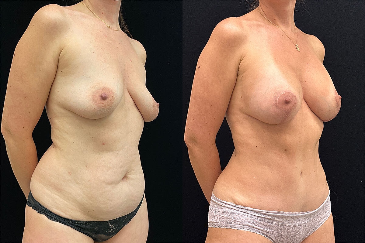 Mommy Makeover Before & After