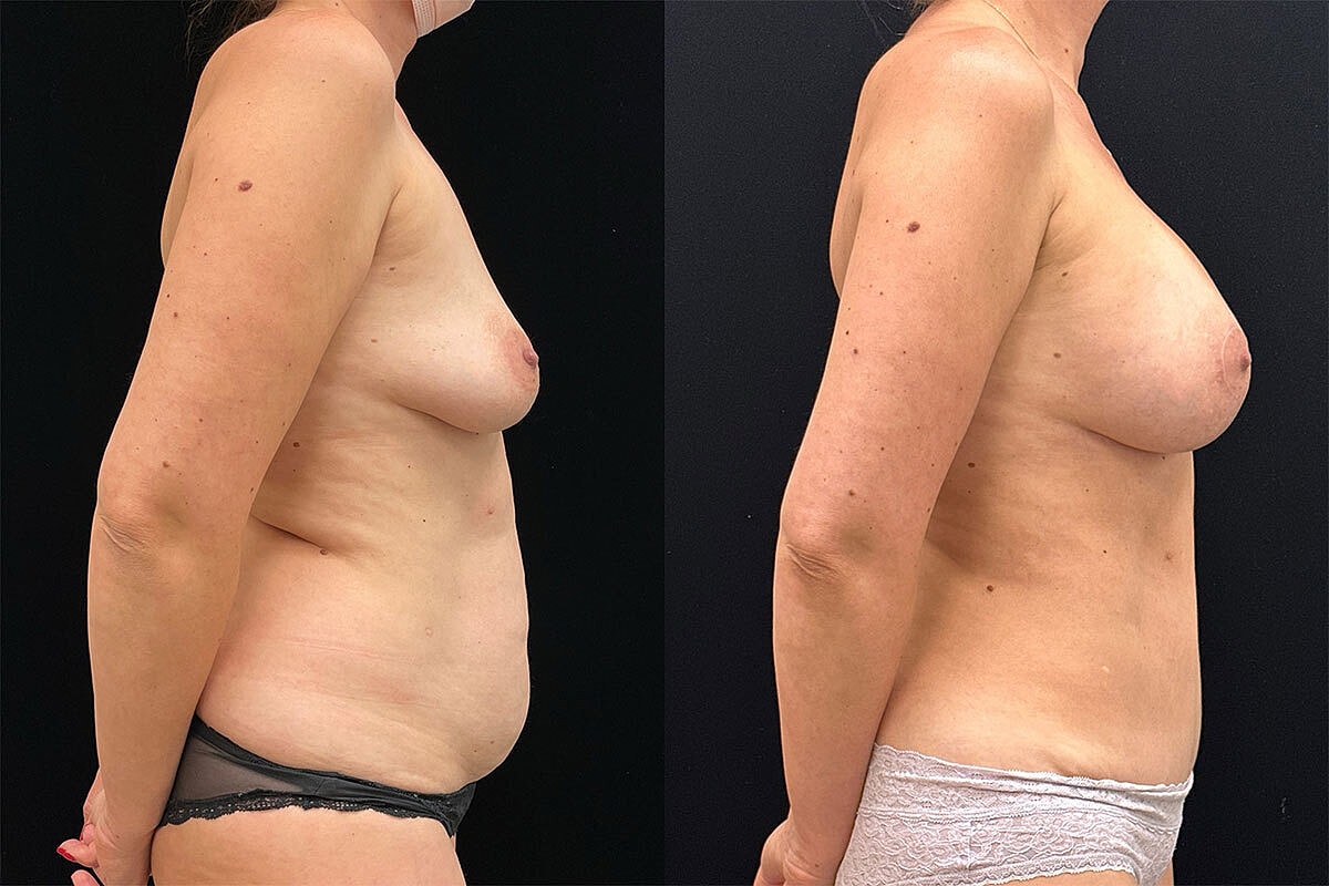 Mommy Makeover Before & After