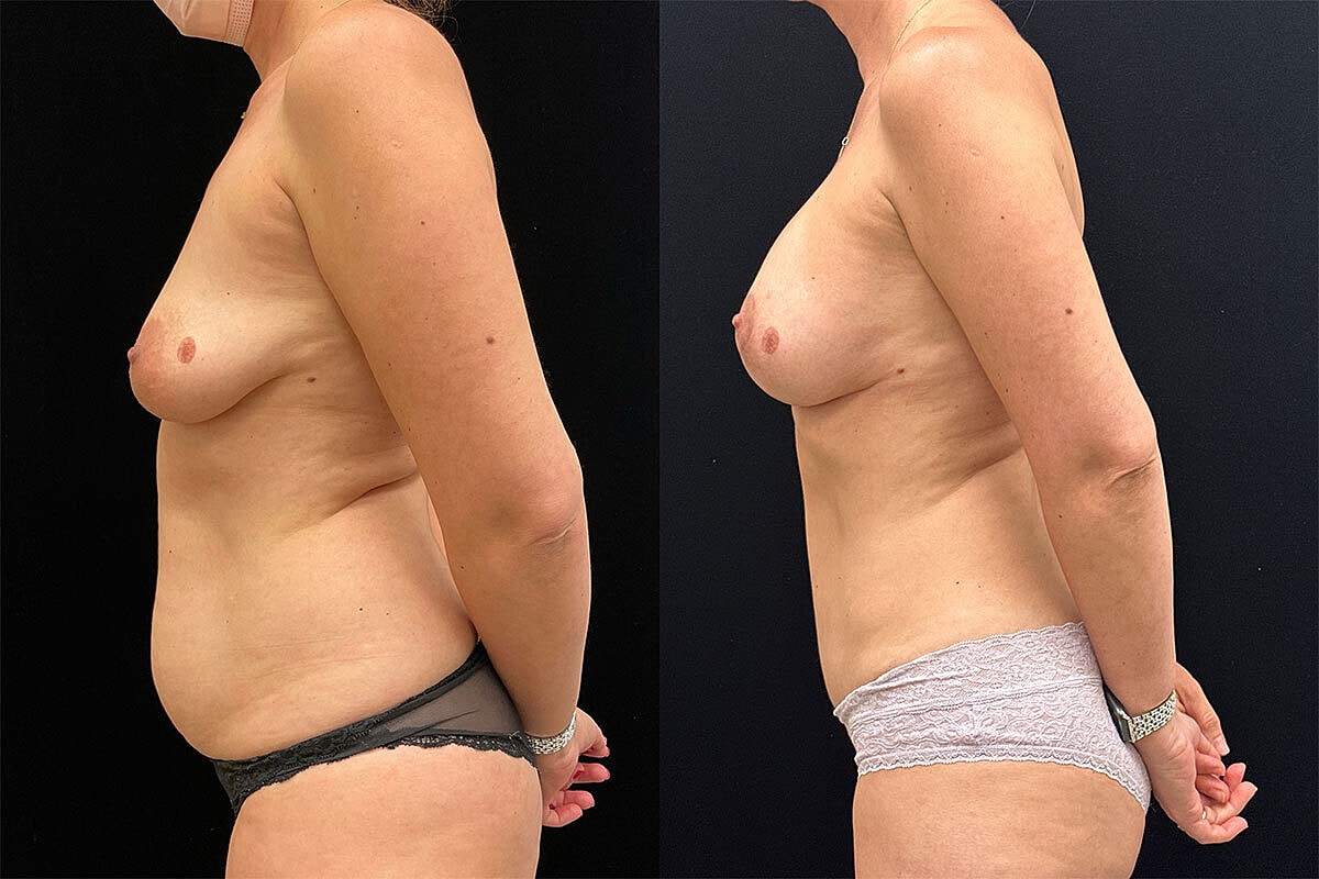 Mommy Makeover Before & After