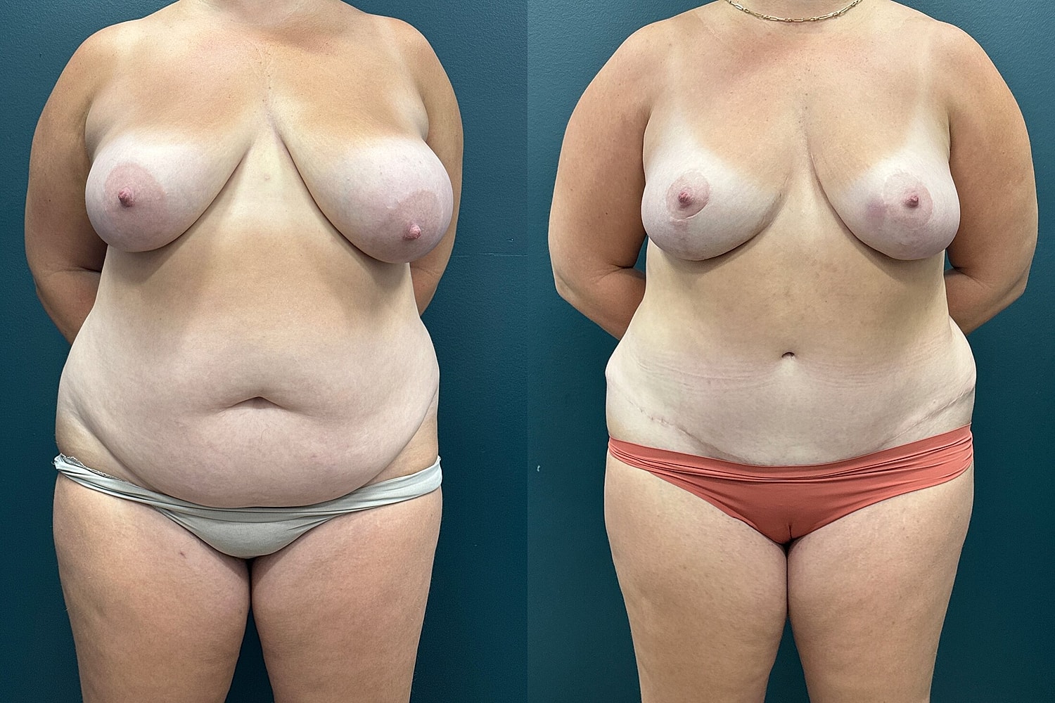 Mommy Makeover Before & After