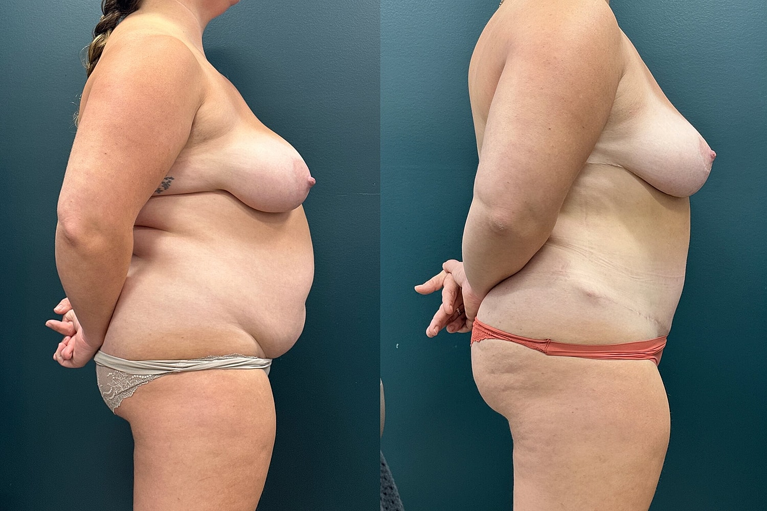 Mommy Makeover Before & After