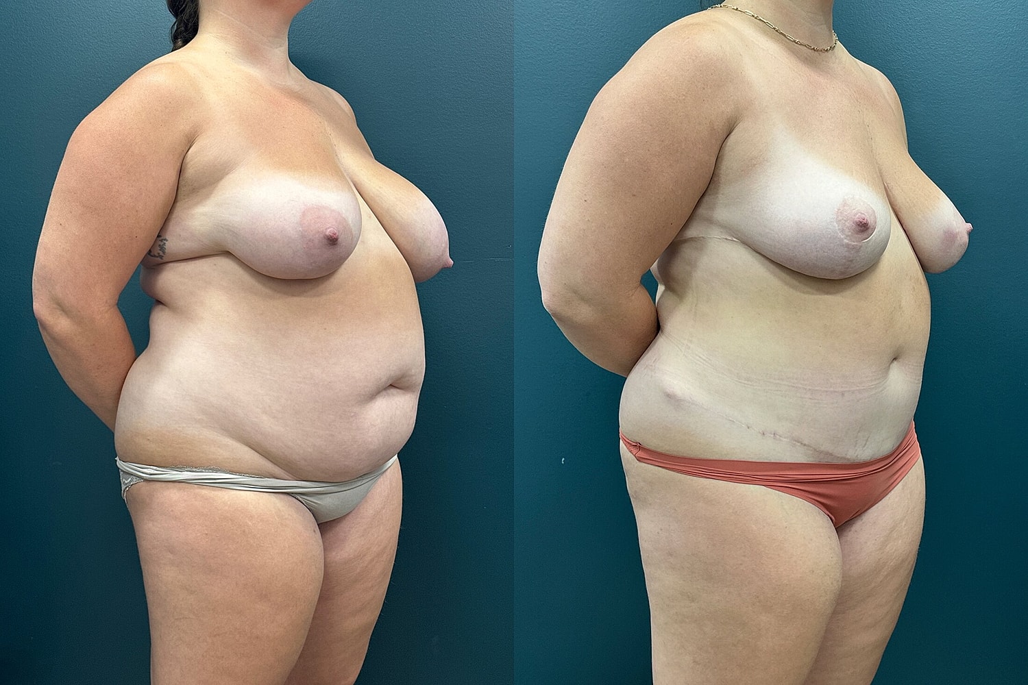 Mommy Makeover Before & After