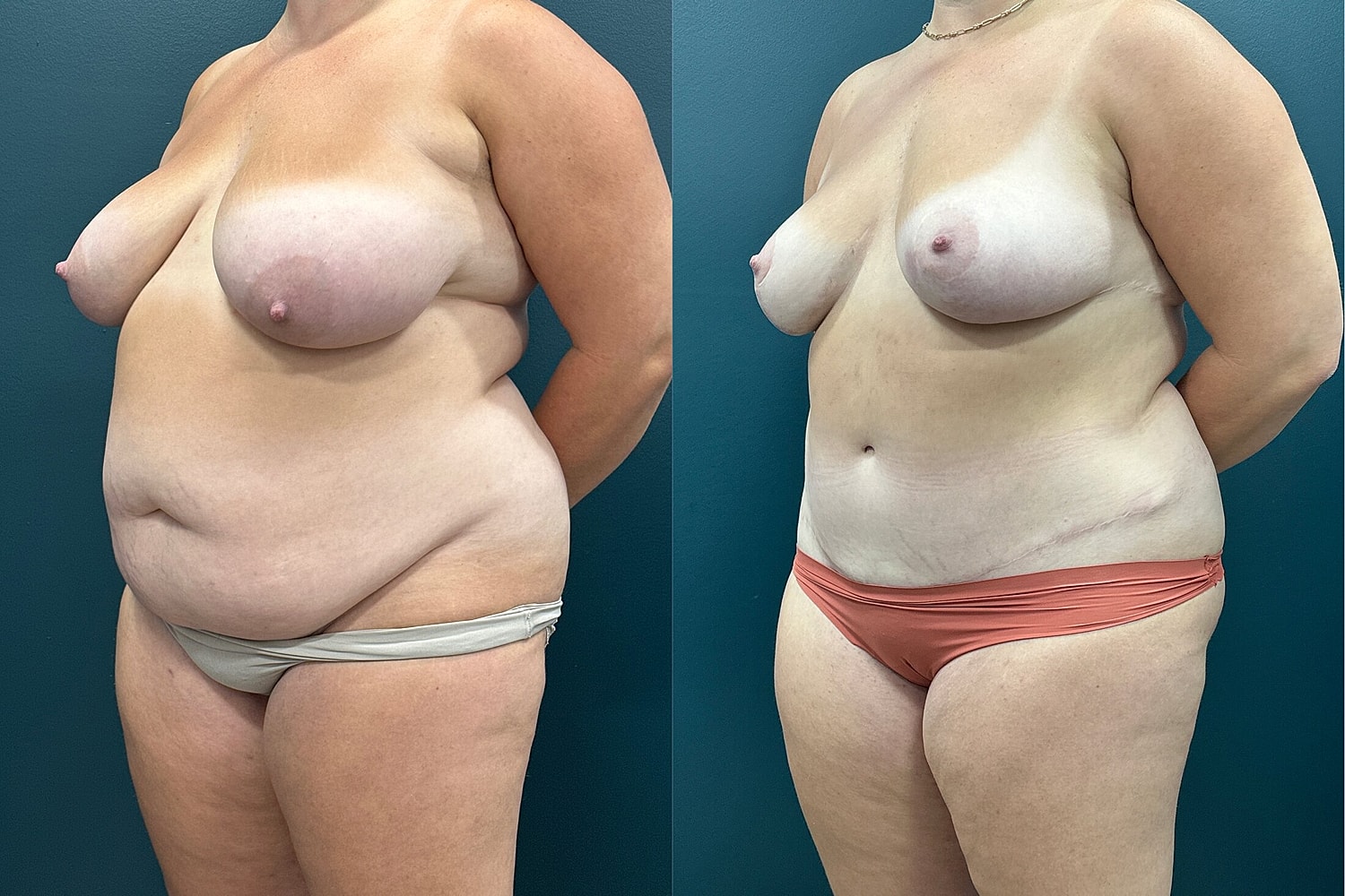 Mommy Makeover Before & After