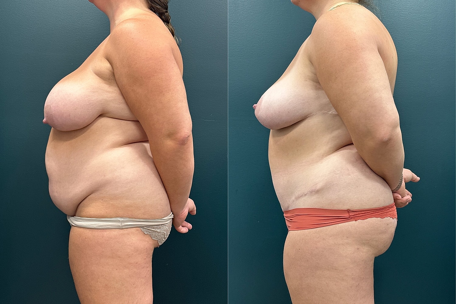 Mommy Makeover Before & After