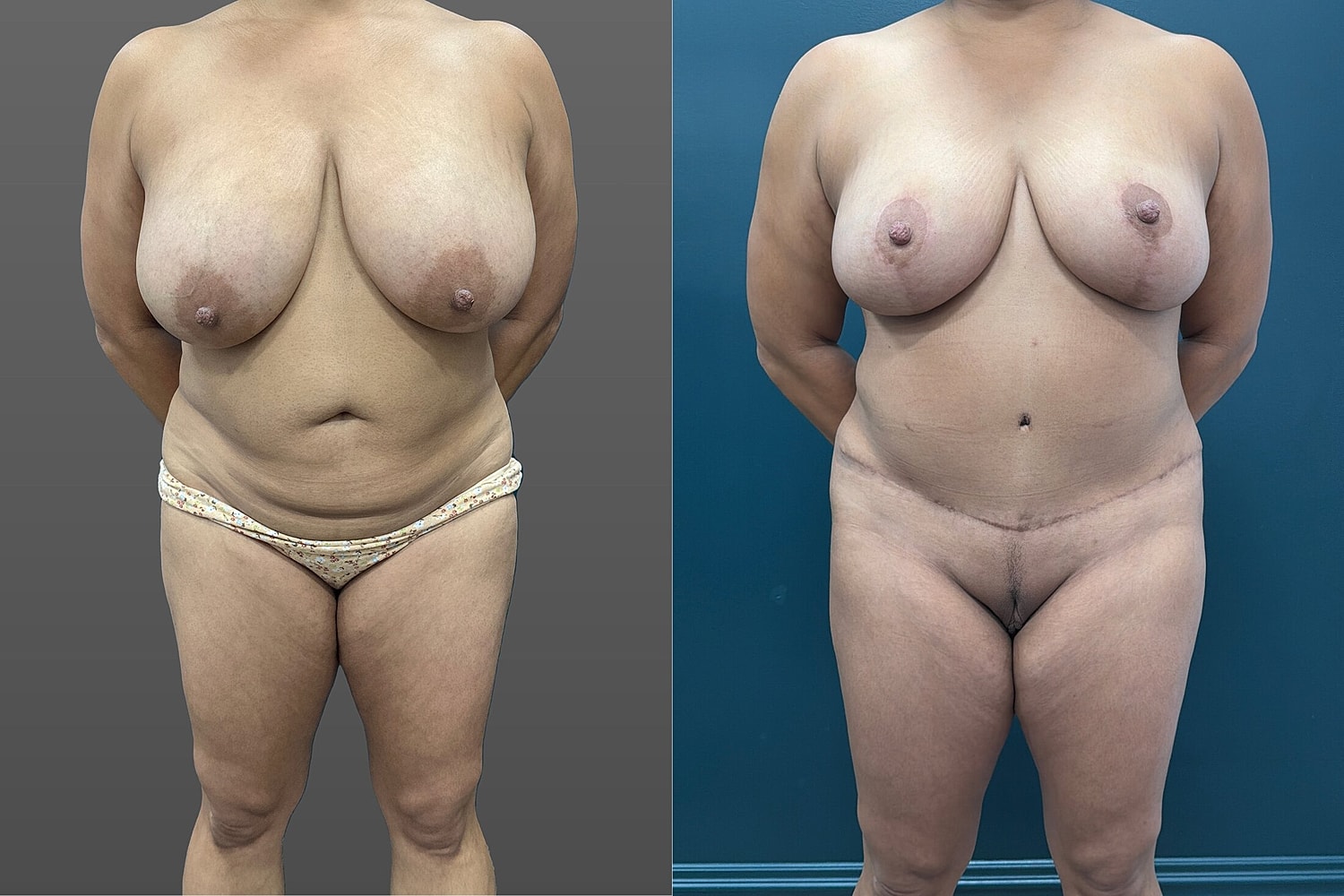 Mommy Makeover Before & After