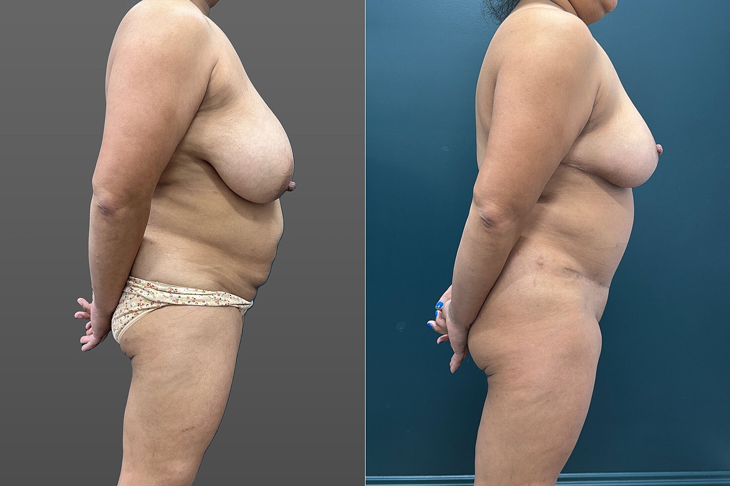 Mommy Makeover Before & After