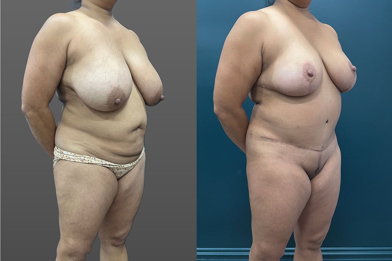 Mommy Makeover Before & After
