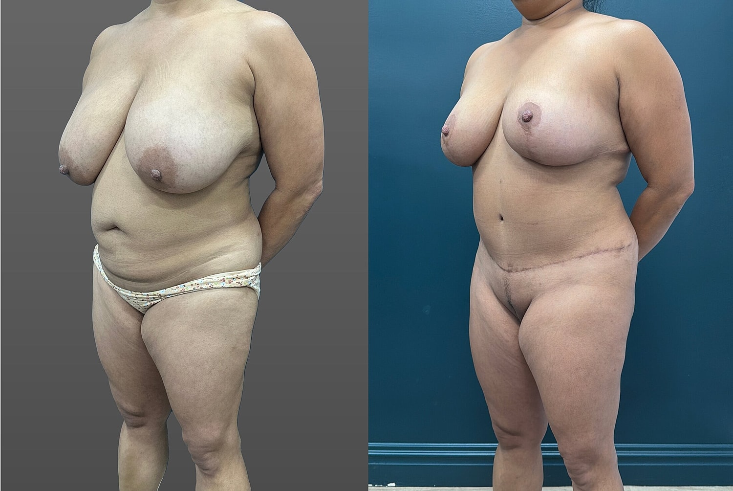 Mommy Makeover Before & After