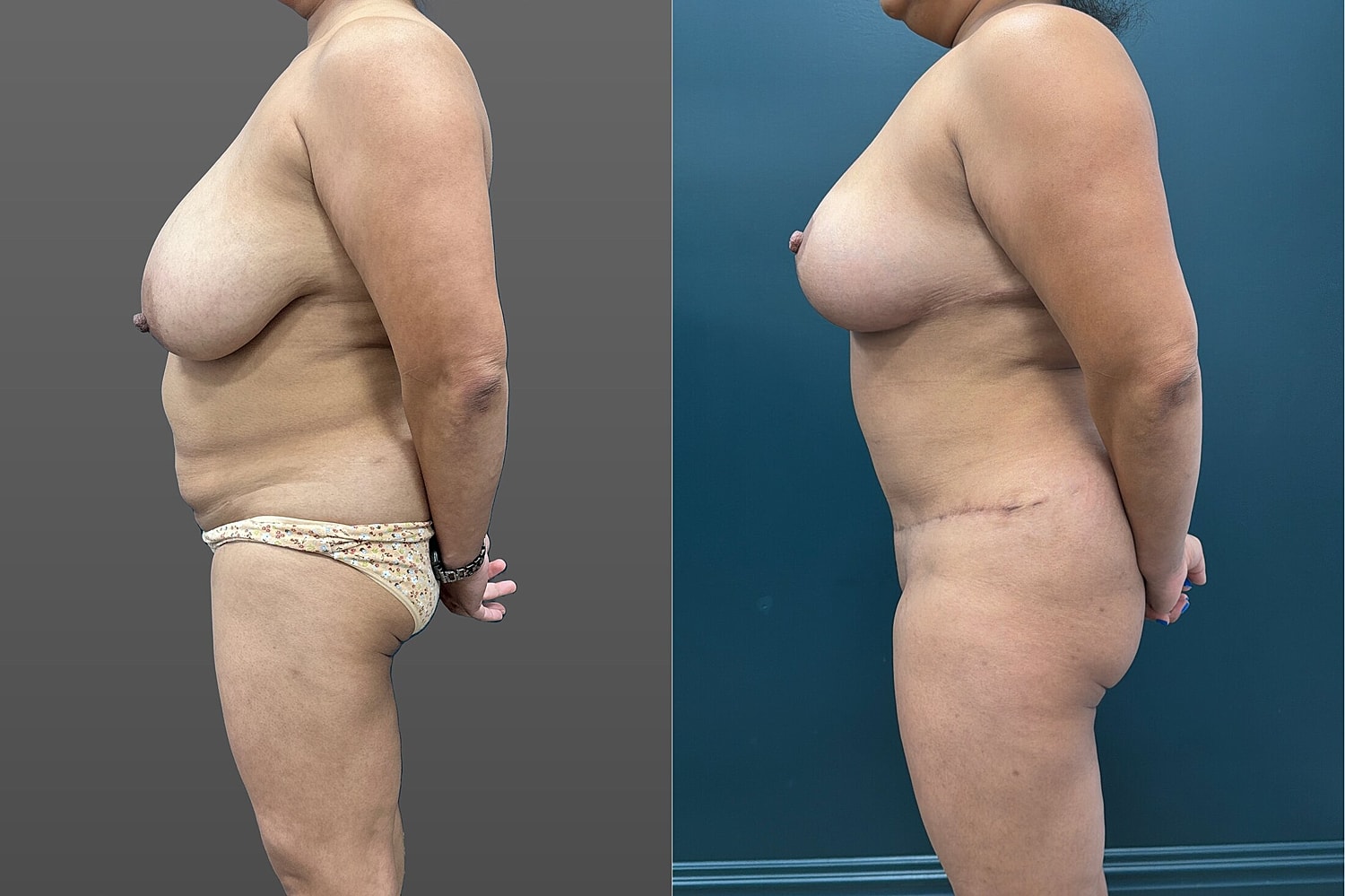 Mommy Makeover Before & After