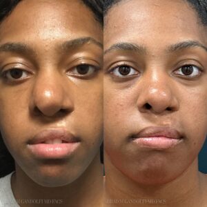 Before and after picture - Brad M Gandolfi MD Facs